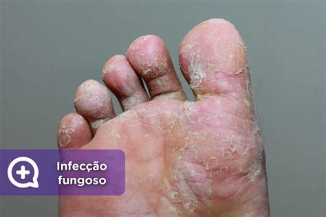 Micose na virilha: sintomas, causas e tratamento